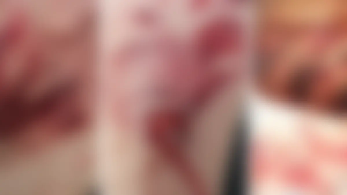 Mit diesen Verletzungsbildern möchte die Polizei vor Hunde-Attacken warnen.