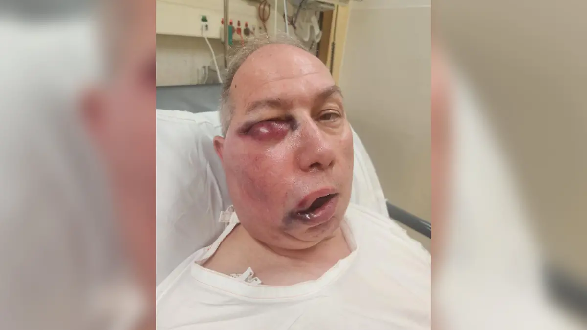 Ein Cricket-Spiel in Australien endet für Schiedsrichter Tony DeNobrega dramatisch. Nach einem Kopftreffer ist sein Gesicht stark entstellt. Ärzte überwachen ihn – eine Operation ist nicht ausgeschlossen.