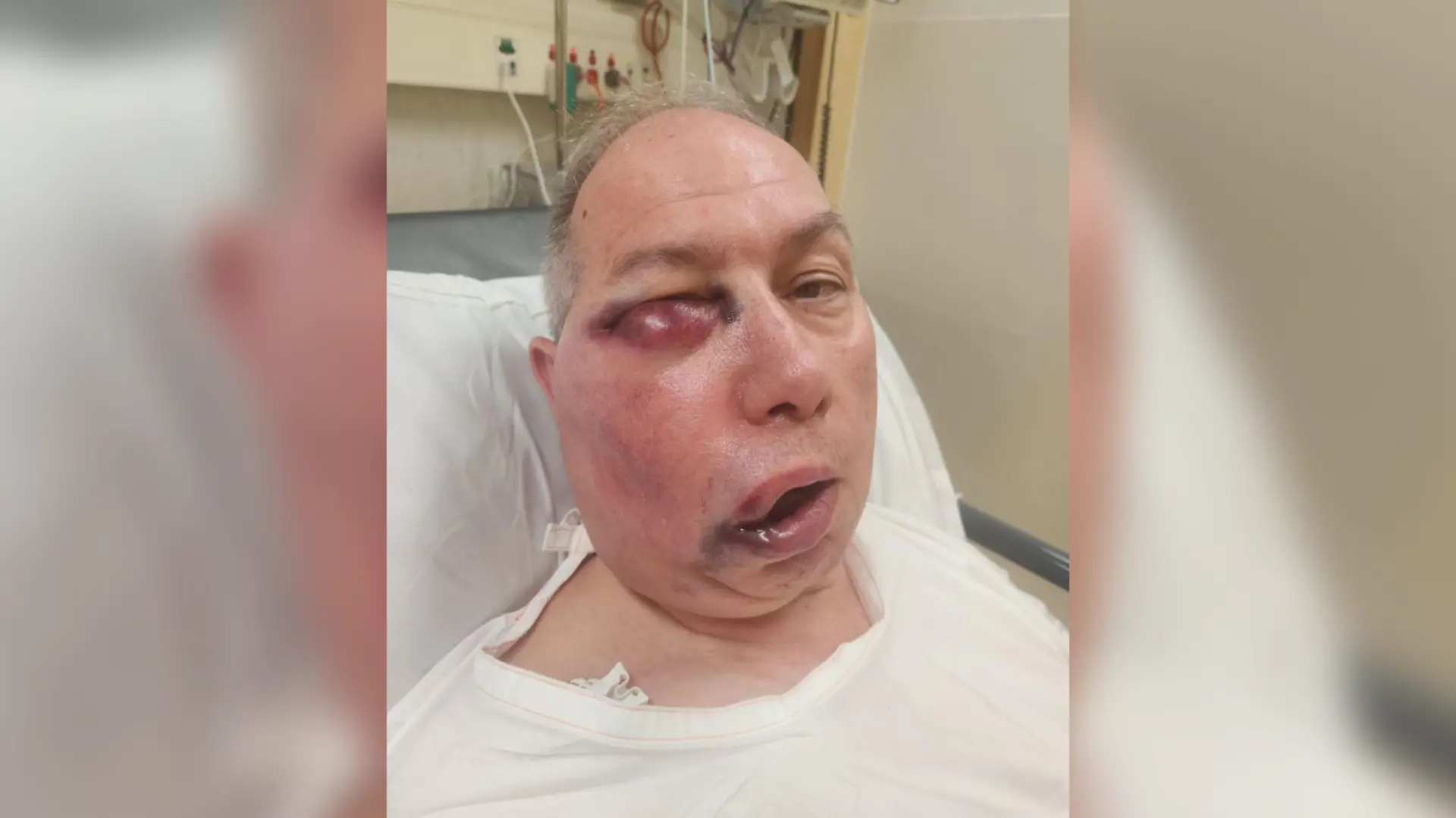 Ein Cricket-Spiel in Australien endet für Schiedsrichter Tony DeNobrega dramatisch. Nach einem Kopftreffer ist sein Gesicht stark entstellt. Ärzte überwachen ihn – eine Operation ist nicht ausgeschlossen.