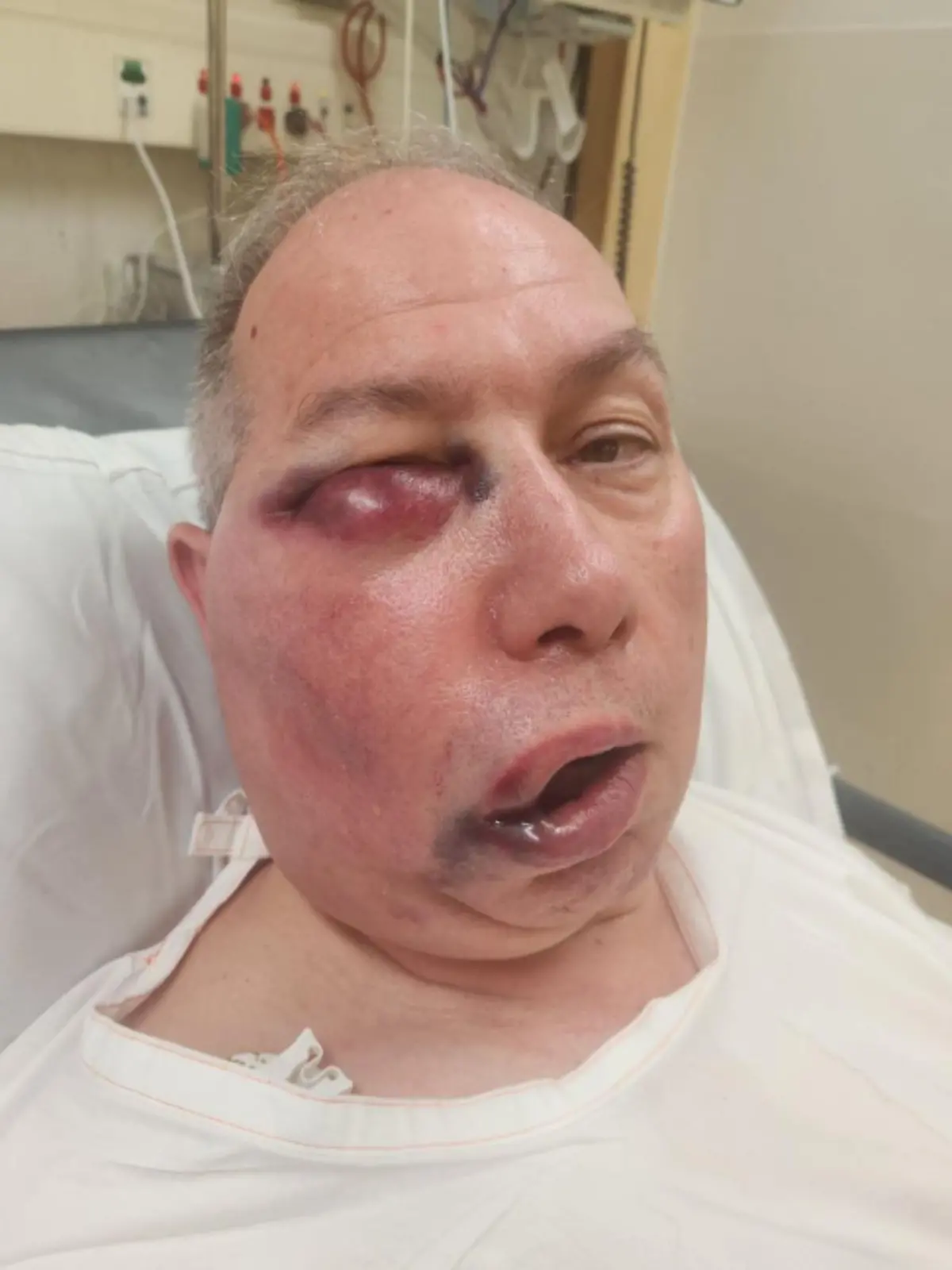 Ein Cricket-Spiel in Australien endet für Schiedsrichter Tony DeNobrega dramatisch. Nach einem Kopftreffer ist sein Gesicht stark entstellt. Ärzte überwachen ihn – eine Operation ist nicht ausgeschlossen.