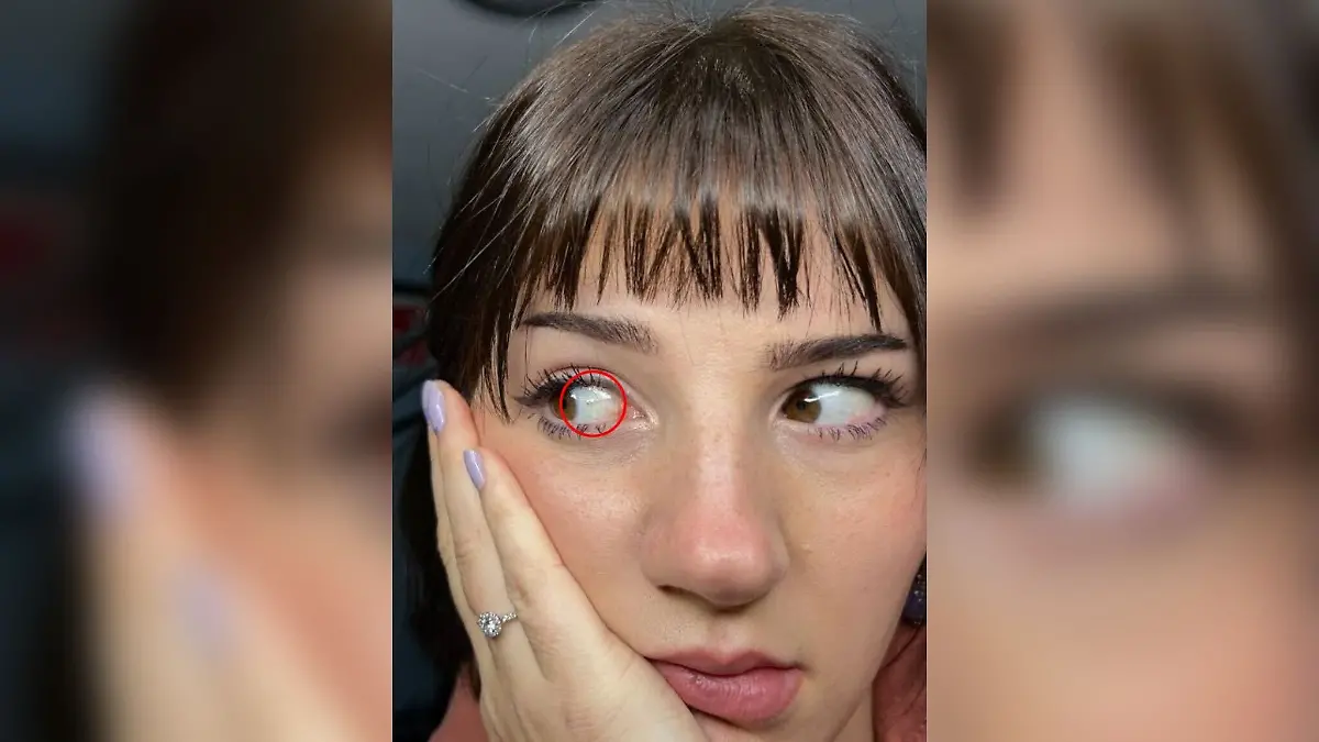 Frau zeigt Splitter im Auge