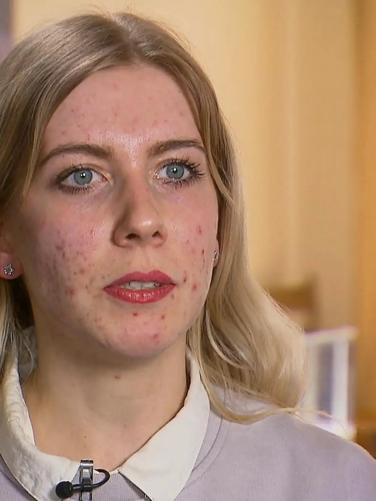 Pia ist 27 Jahre alt und leidet extrem unter ihrer Akne. Die vielen Pickel machen ihr zu schaffen; viele Hautstellen sind bereits vernarbt. Ohne Make-up fühlt sie sich einfach nur unwohl. Jetzt testet sie eine neue Laserbehandlung. Ob diese funktioniert?