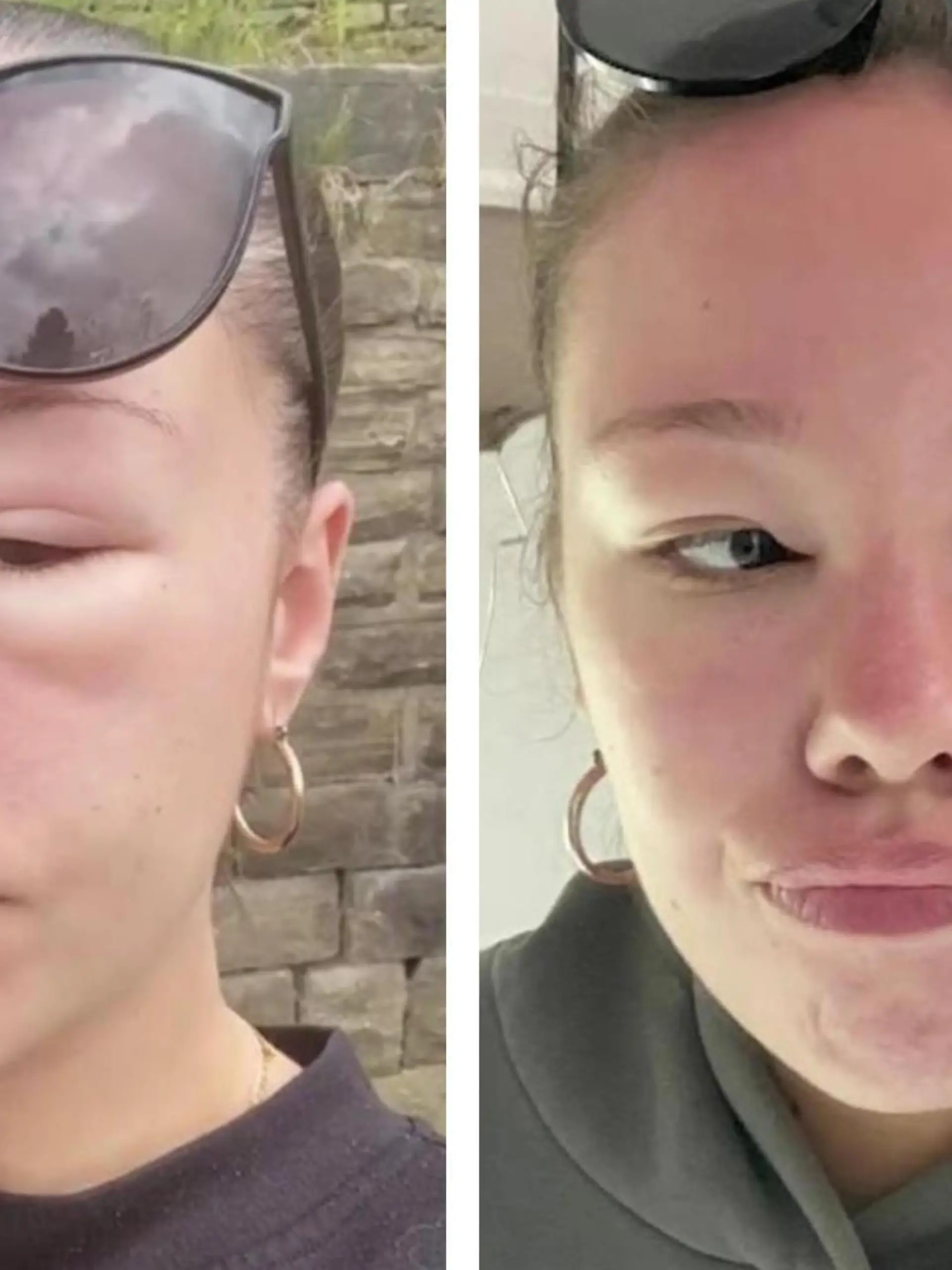 Sonnenbrand, Sonnenstich - aber eine Sonnenvergiftung? Das gibt's tatsächlich! Davon kann die Britin Orla McGlynn ein Lied singen. Weil sie sich nicht ausreichend vor der Sonne geschützt hat, schwillt ihr Gesicht an und ihre Haut zeigt eine unerwartete, aber extreme Reaktion.