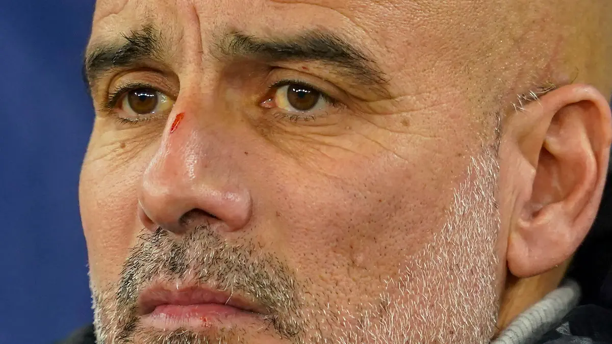 Pep Guardiola mit Kratzer auf der Nase.
