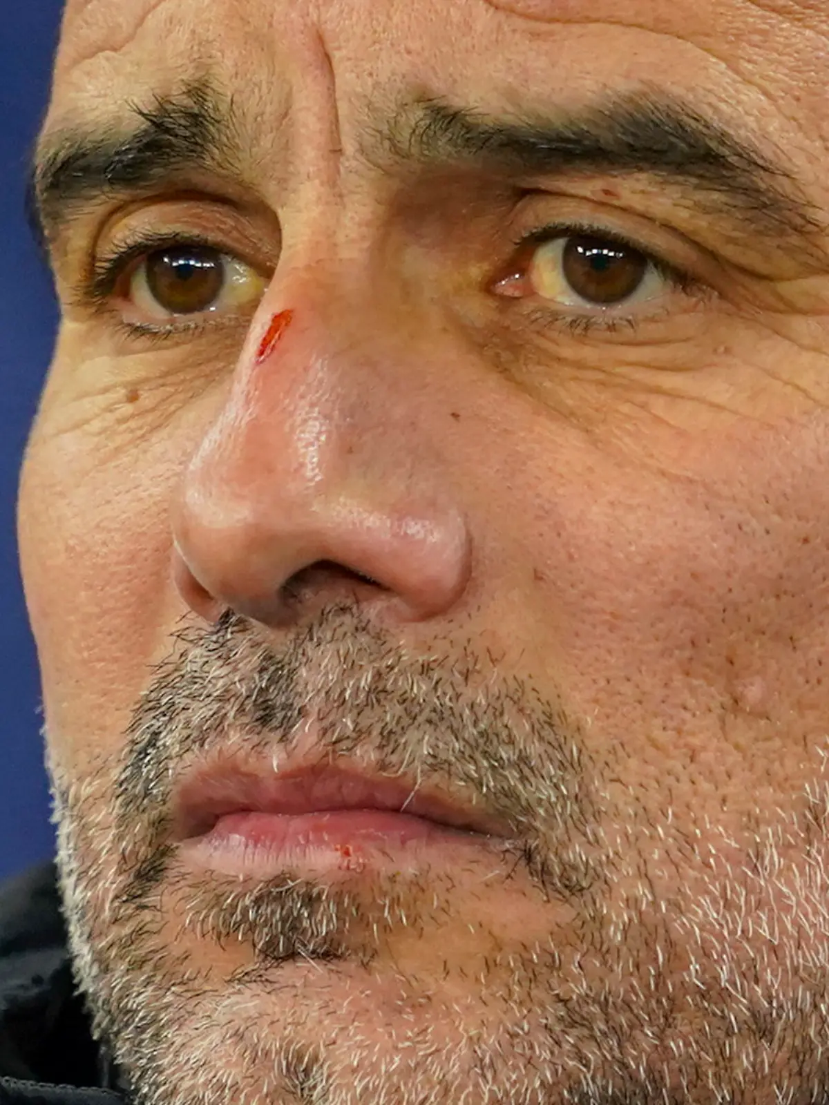Pep Guardiola mit Kratzer auf der Nase.