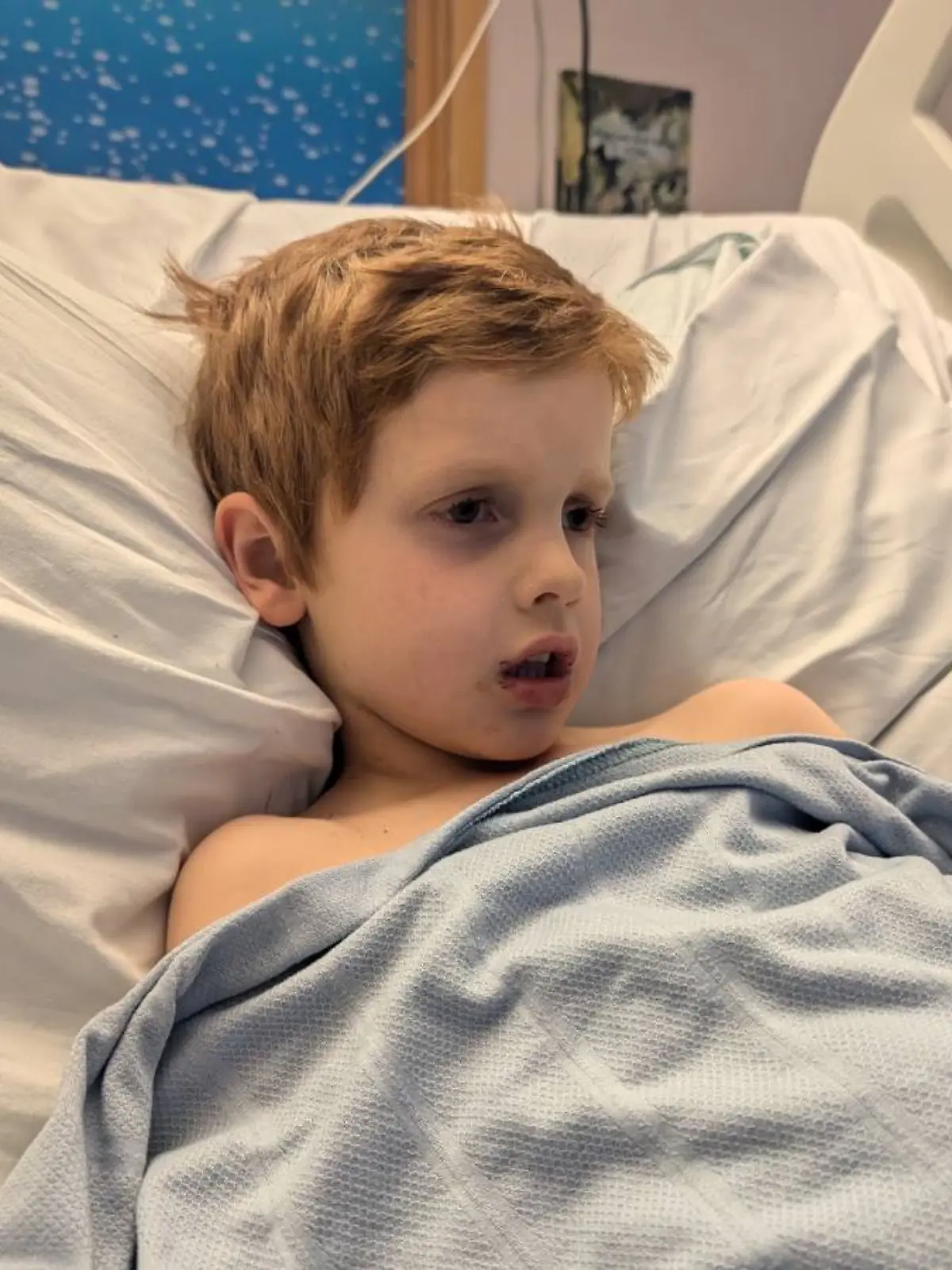 Jasper (5) hat die seltene Krankheit Hämophagozytische Lymphohistiozytose (HLH).