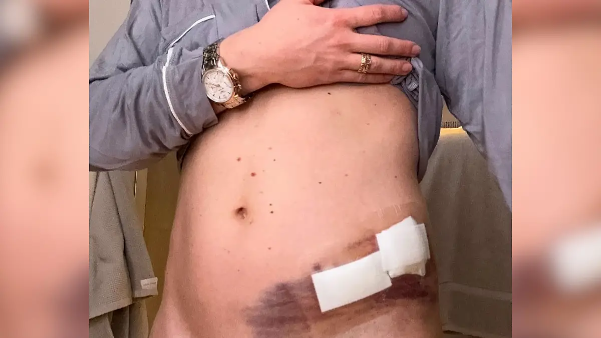Mikaela Shiffrin zeigt ihren Bauch, der durch eine Stichwunde stark blau angelaufen ist.