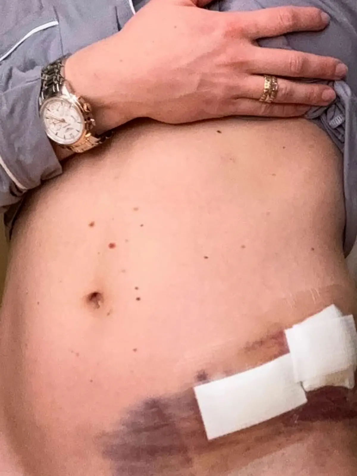Mikaela Shiffrin zeigt ihren Bauch, der durch eine Stichwunde stark blau angelaufen ist.