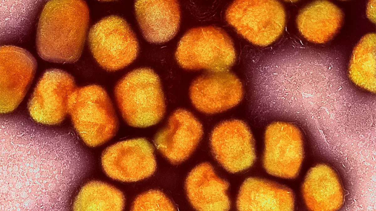 In Deutschland ist zum zweiten Mal die neue Variante des Mpox-Virus nachgewiesen worden, vier Mitglieder einer Familie im Rheinisch-Bergischen Kreis bei Köln sind erkrankt (Archivbild).