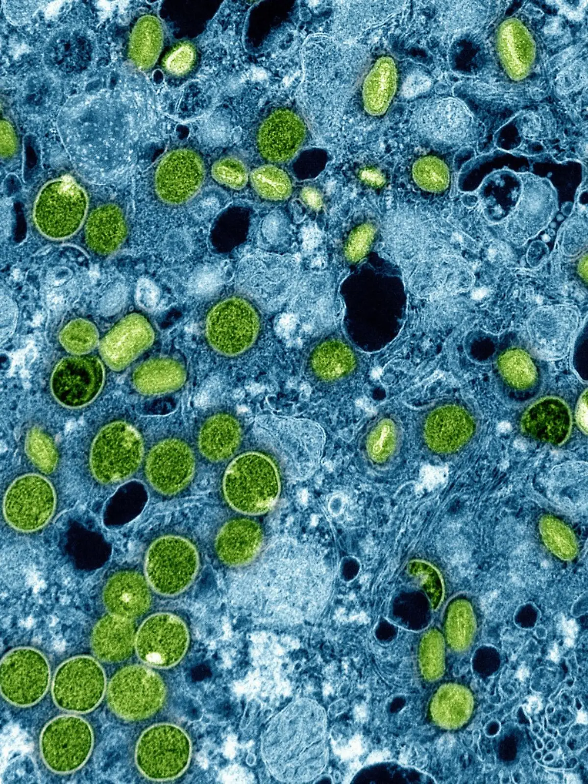 Bild zu: "Chef von Gesundheitsbehörde warnt! Hunderte Mpox-Patienten auf der Flucht"