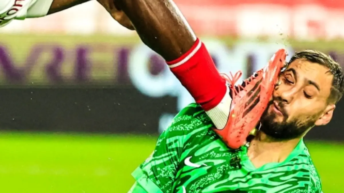 Im Liga-Spiel gegen den AS Monaco wird PSG-Keeper Gianluigi Donnarumma (25) übel im Gesicht verletzt. Die Fleischwunden mussten geklammert und getackert werden!