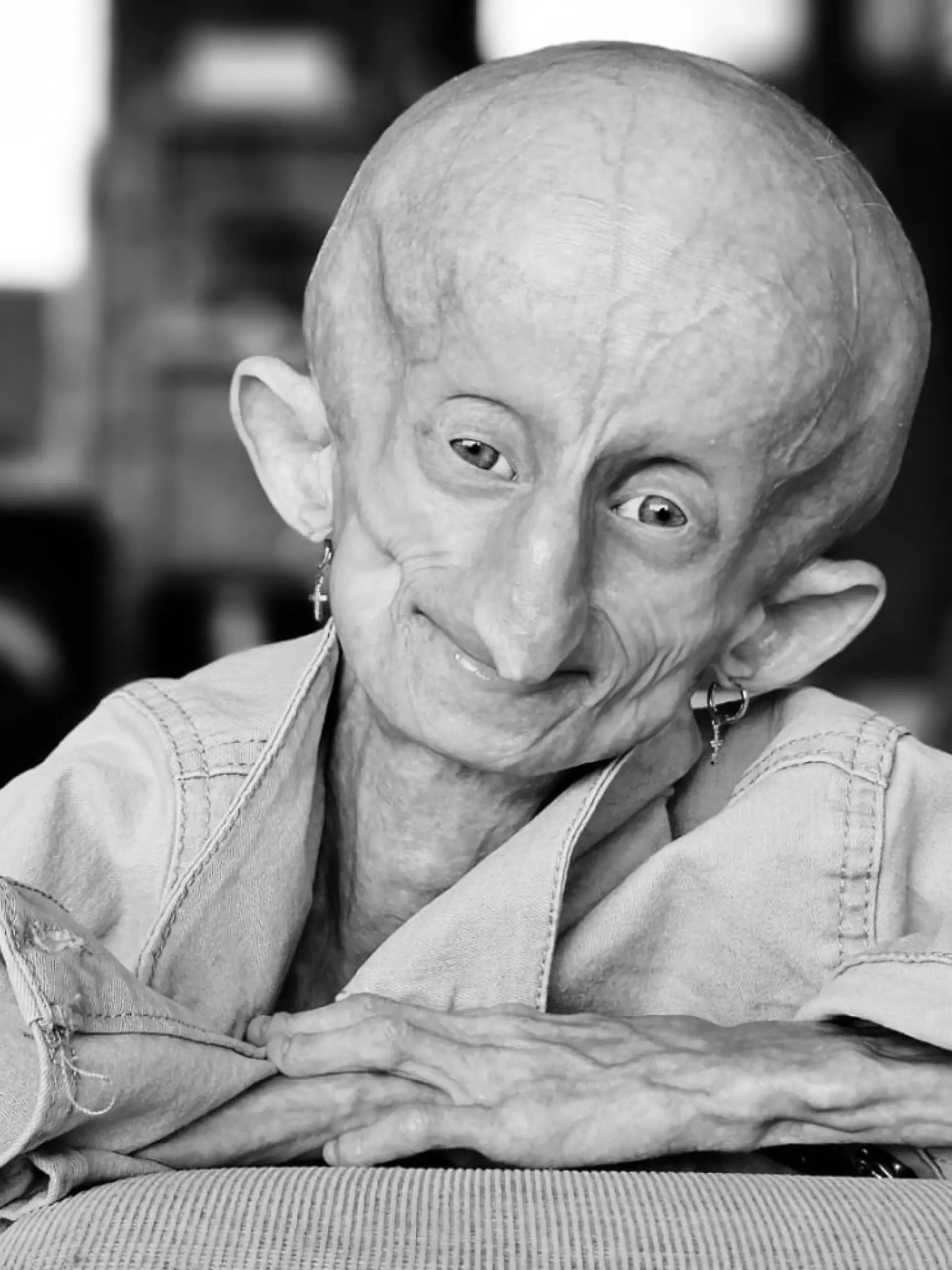 Die an Progerie erkrankte Beandri Booysen war für viele eine große Inspiration. Sie wurde nur 19 Jahre alt.