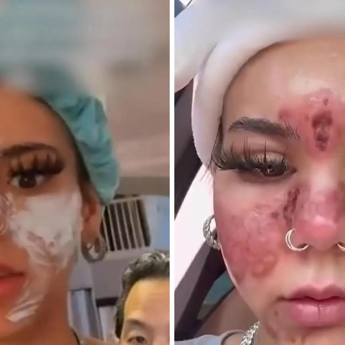 Beauty-Doc warnt vor dieser Behandlung: Verbrennungen im Gesicht! Frau  nutzt abgelaufene Kosmetik