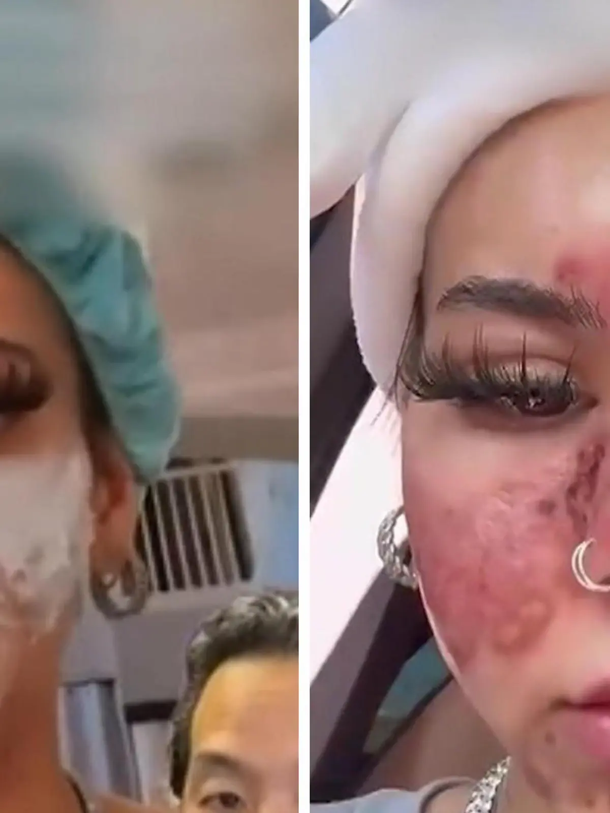 Frau entwickelt durch abgelaufene Kosmetik schmerzhafte Wunden.