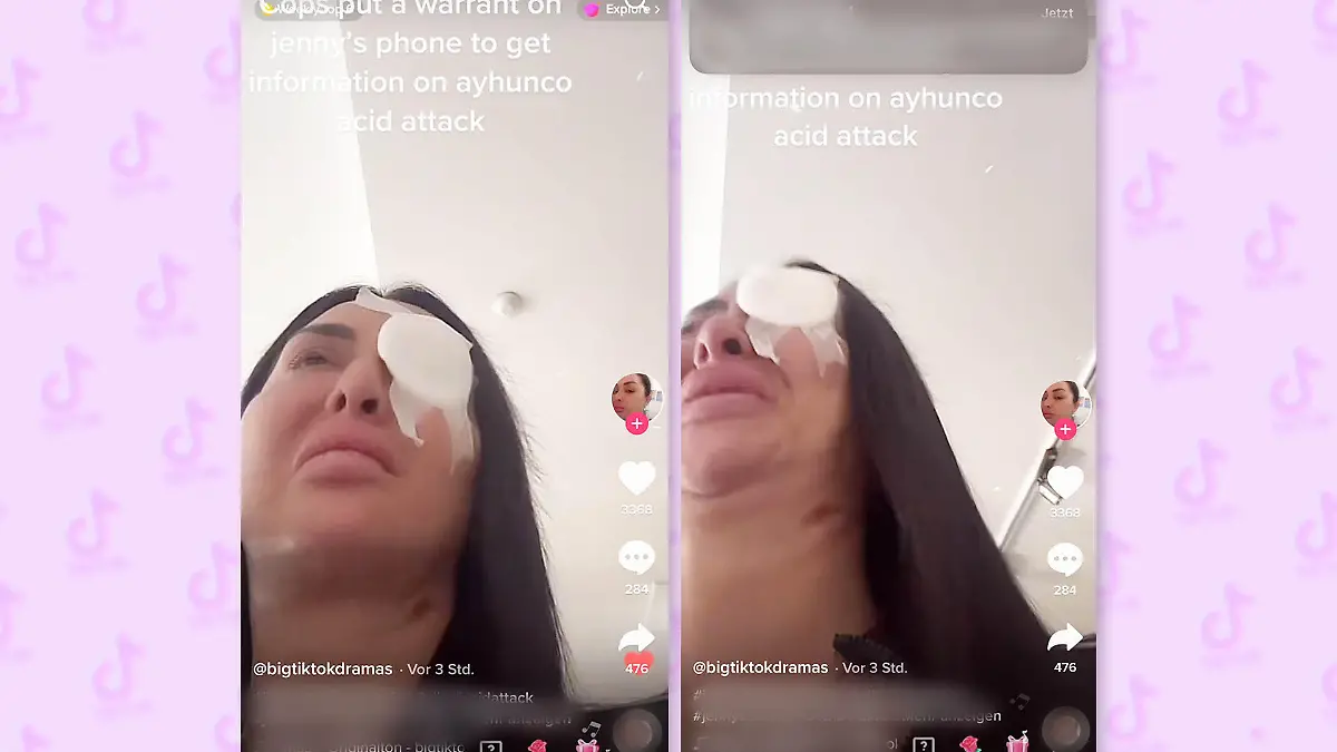 Das Auge von Jenny Elhassan ist abgeklebt. Ärzte haben die 32-Jährige nach der Säure-Attacke versorgt.