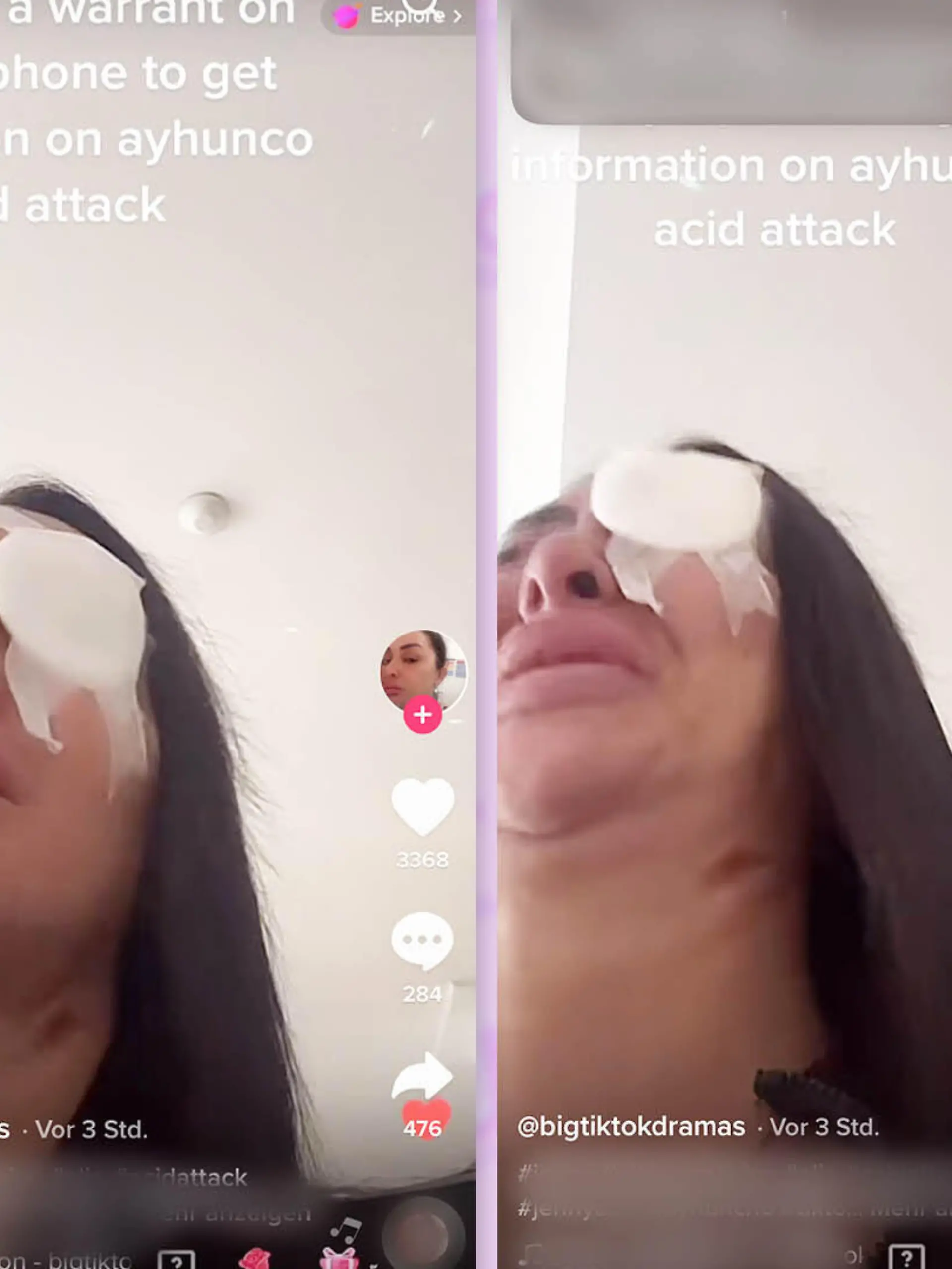 Das Auge von Jenny Elhassan ist abgeklebt. Ärzte haben die 32-Jährige nach der Säure-Attacke versorgt.