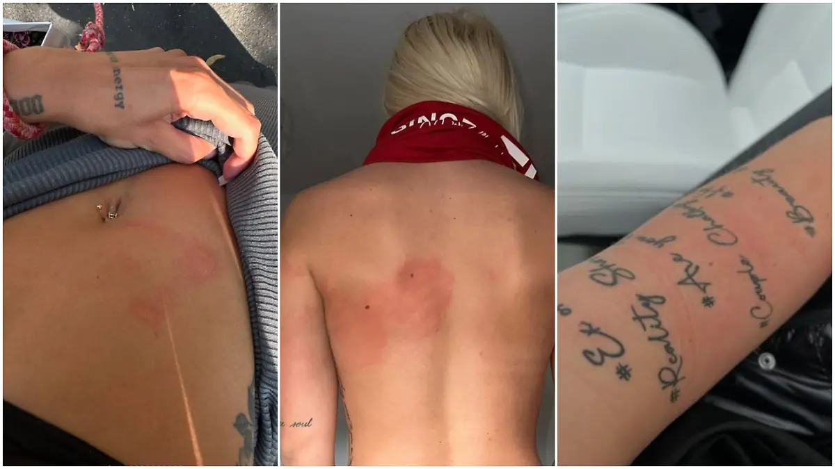 Walentina postet Fotos von sich, die Spuren der angeblichen häuslichen Gewalt zeigen.