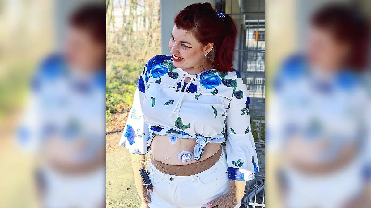 Kathi mit Kompressionsstrümpfe und Insulinpumpe
