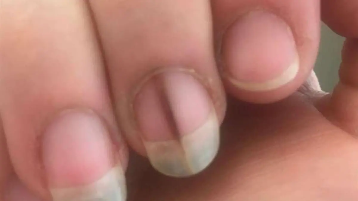 Mit diesem Strich am Fingernagel stellte sich Heather bei ihrem Arzt vor. 