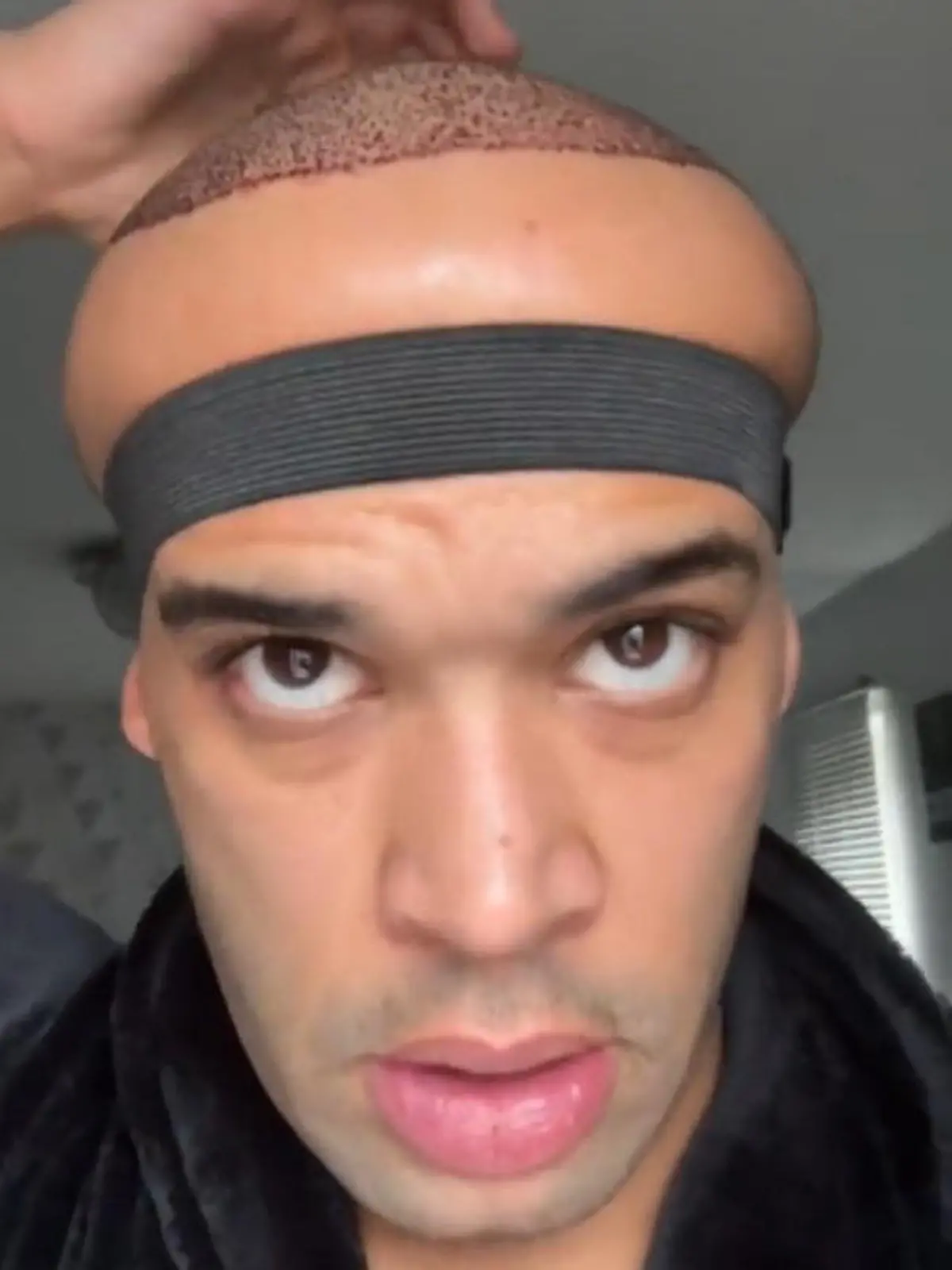 Influencer Kanah Flex hat sich einer Haartransplantation unterzogen. Doch dann schwillt sein Kopf extrem an