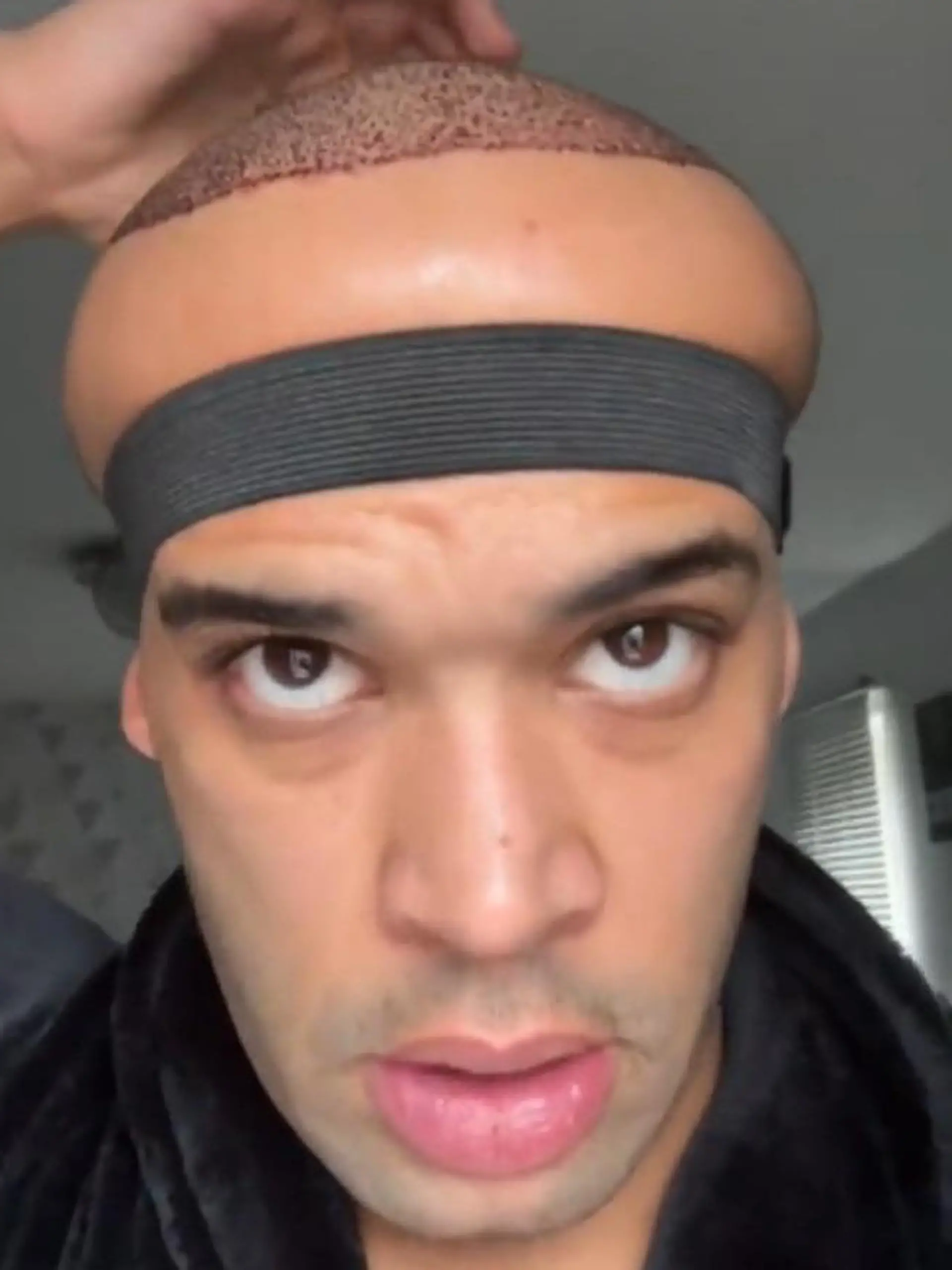 Influencer Kanah Flex hat sich einer Haartransplantation unterzogen. Doch dann schwillt sein Kopf extrem an