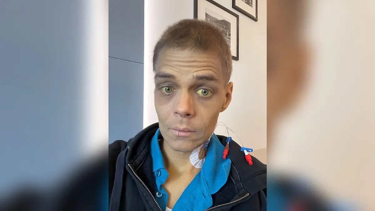 Die Haut des 36-Jährigen ist durch die Krebserkrankung gelb gefärbt