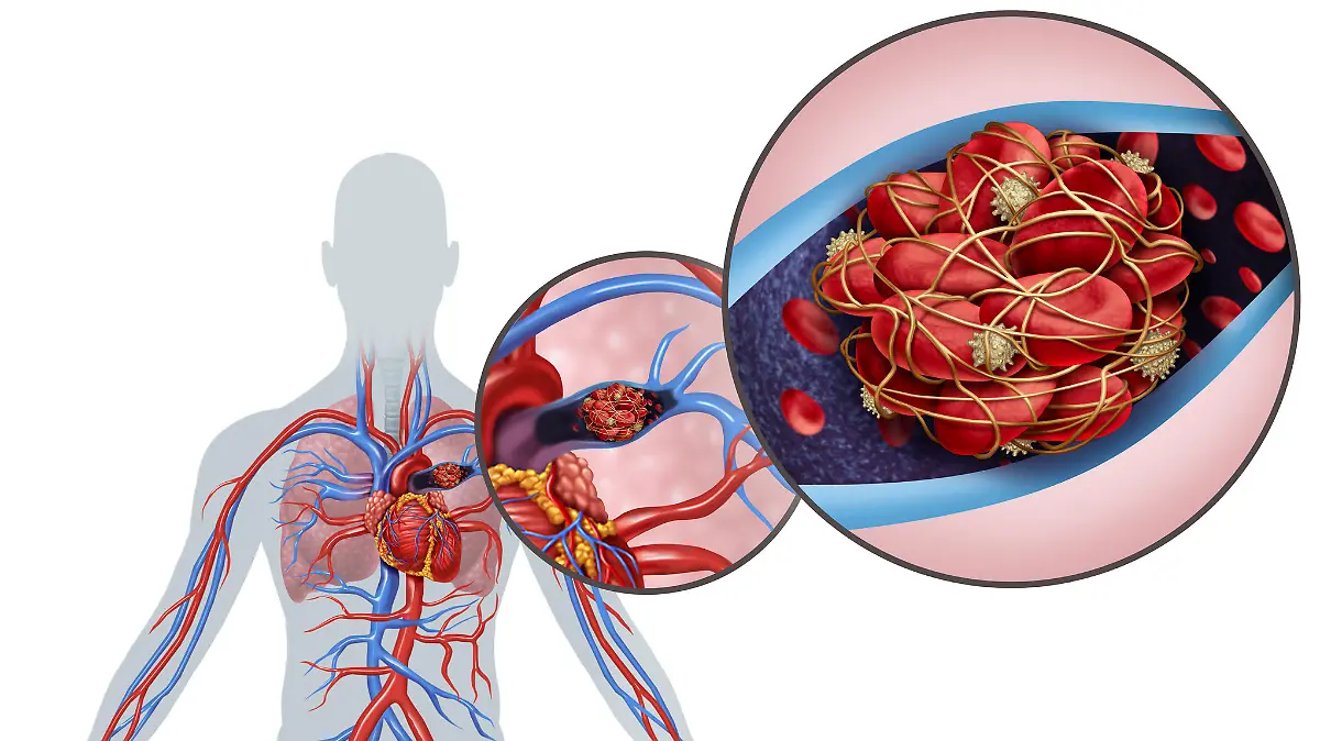 Pulmonary Embolism with a blood clot as a disease with a blockage of an artery in the lungs with 3D illustration elements.