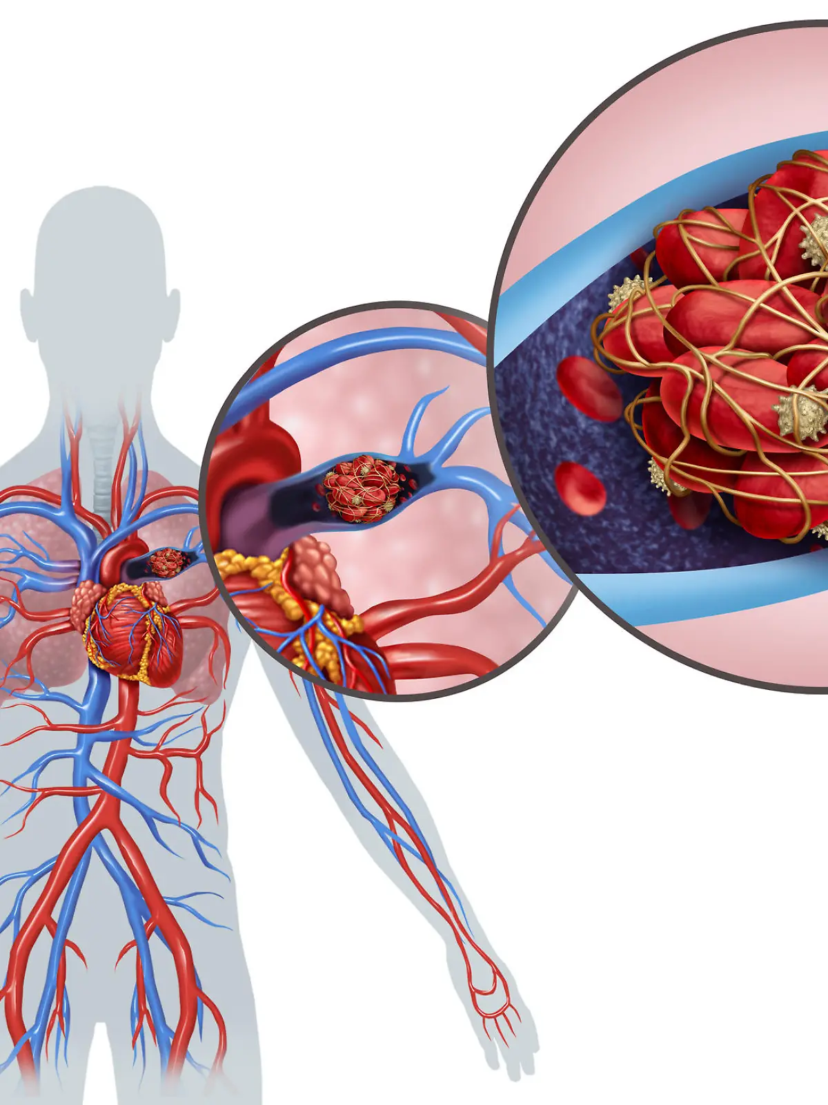 Pulmonary Embolism with a blood clot as a disease with a blockage of an artery in the lungs with 3D illustration elements.