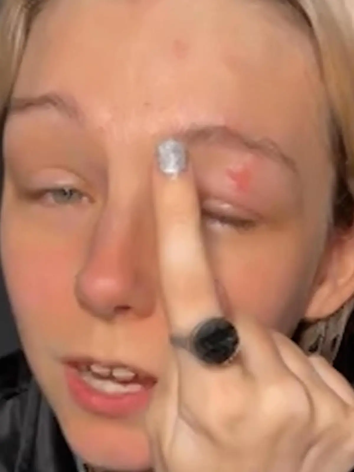 Wegen TikTok-Verbot! Nicolette (28) hat Gürtelrose in den Augen