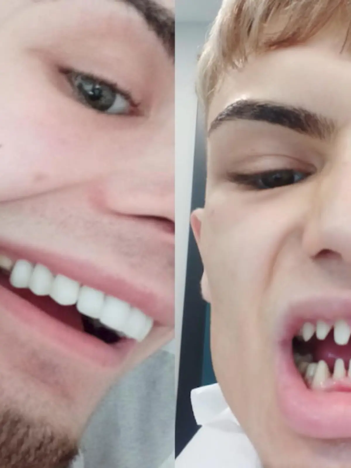 Jack James aus Großbritannien träumt von einem strahlend weißen Zahnpasta-Lächeln! Und dafür nimmt er einiges in Kauf: Weil er sich die Zahnbehandlung für Veneers in seinem Heimatland nicht leisten kann, fliegt er in die Türkei. Doch das geht gehörig schief.