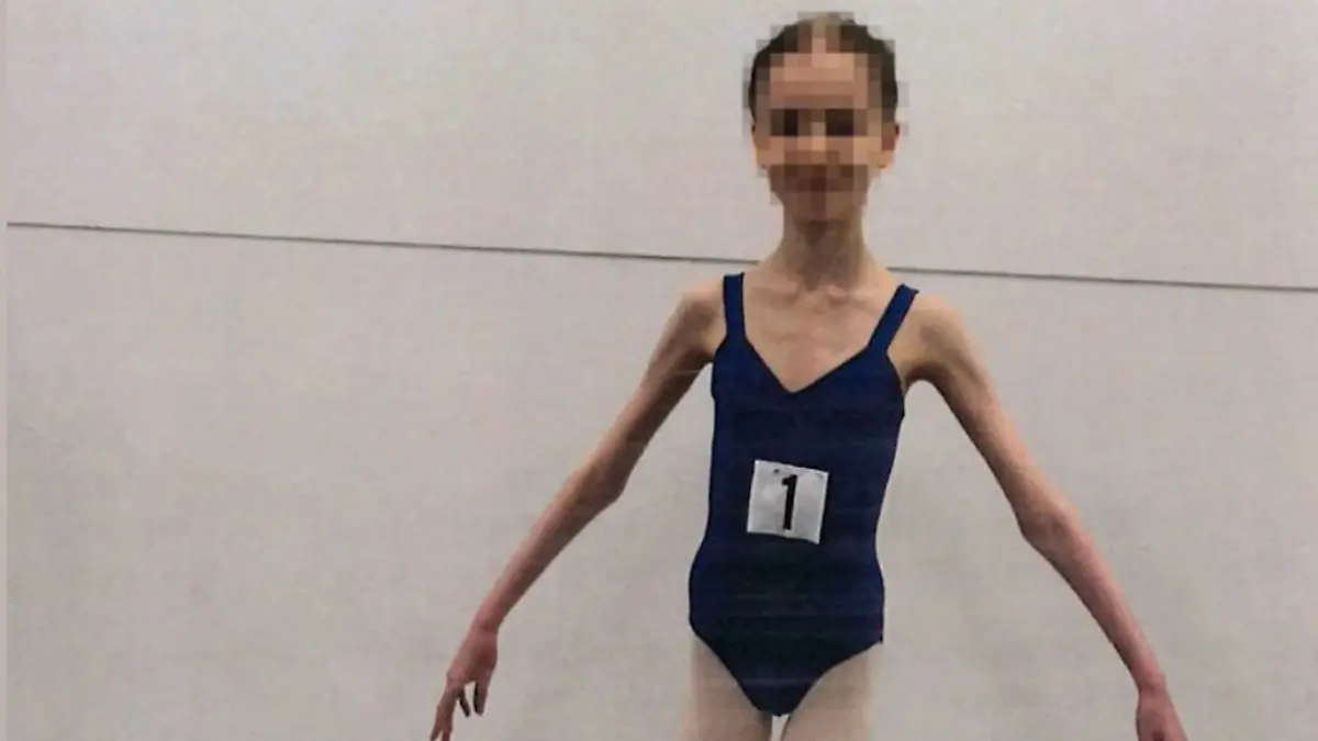 Das Mädchen aus Australien wog zur schlimmsten Zeit nur noch 27 Kilo – mit 17 Jahren.