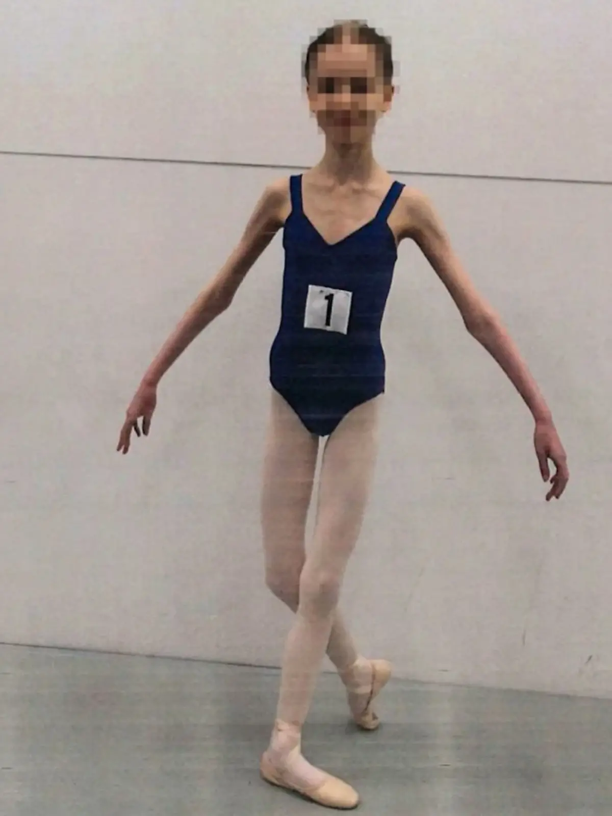 Das Mädchen aus Australien wog zur schlimmsten Zeit nur noch 27 Kilo – mit 17 Jahren.