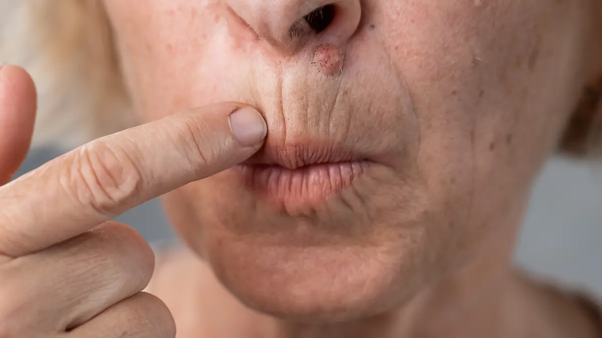 Falten um den Mund werden durch häufige Kontraktionen des Ringmuskels begünstigt.