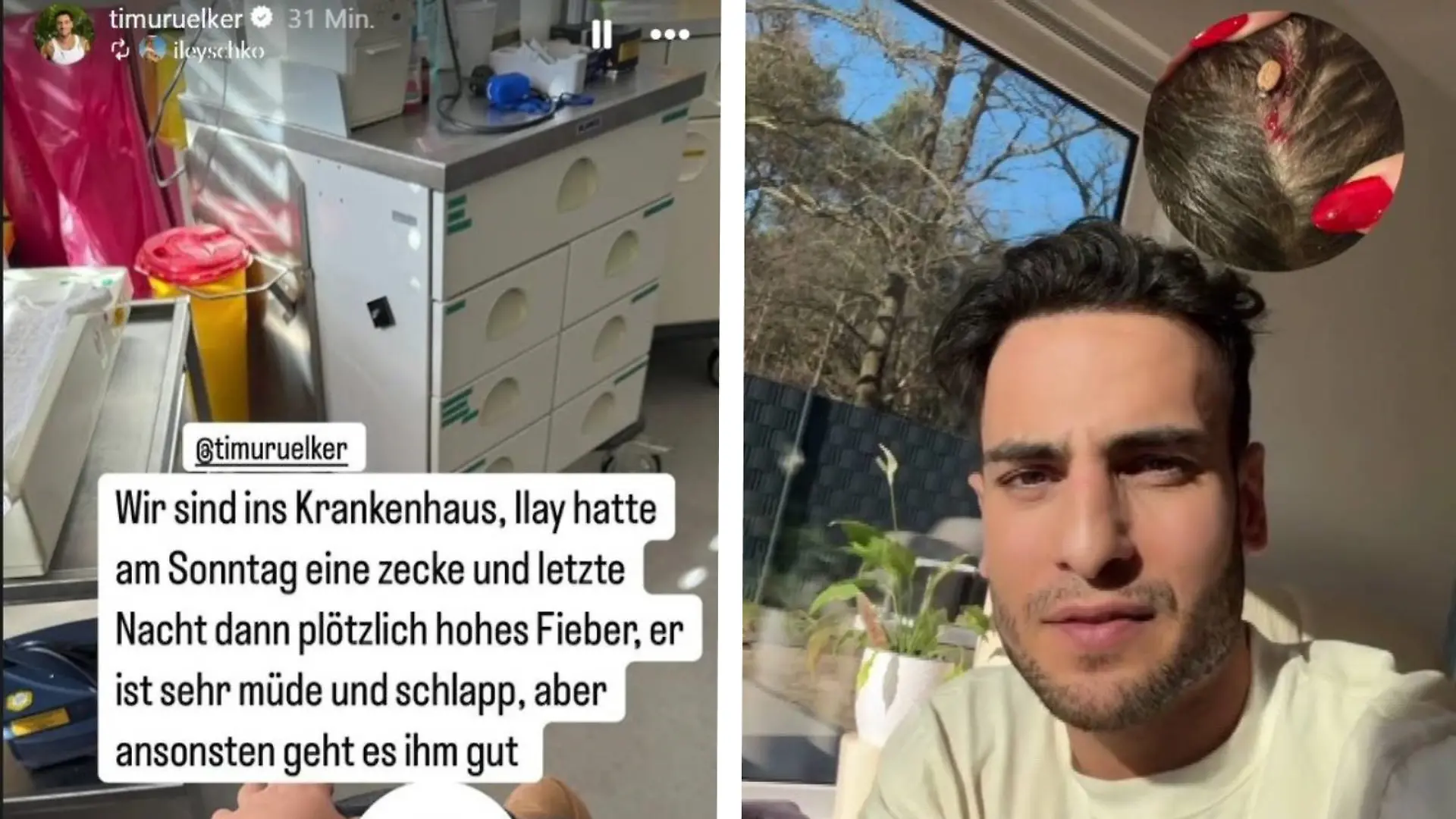 Timur Ülkers Sohn Ilay (5) wurde von einer Zecke gebissen, die sich am Kopf vollgesogen hat! Das erzählt der GZSZ-Schauspieler auf Instagram.