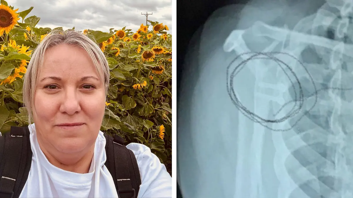Angela Glover (51) aus Großbritannien gerät an einen Chirurgen, der regelmäßig OPs verpfuschte und Patienten sogar unter anderem falsche Knochen entfernte!