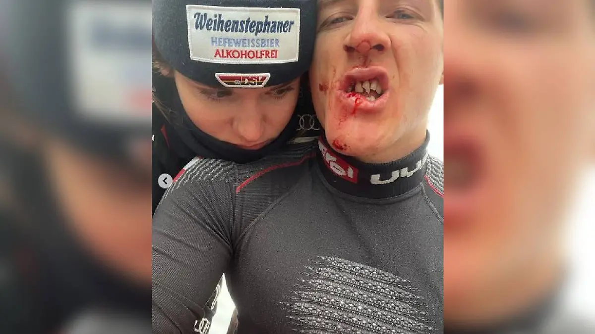 Fabiana Dorigo postet ein Foto von den blutigen Zähnen ihres Freundes Raphael Haaser.