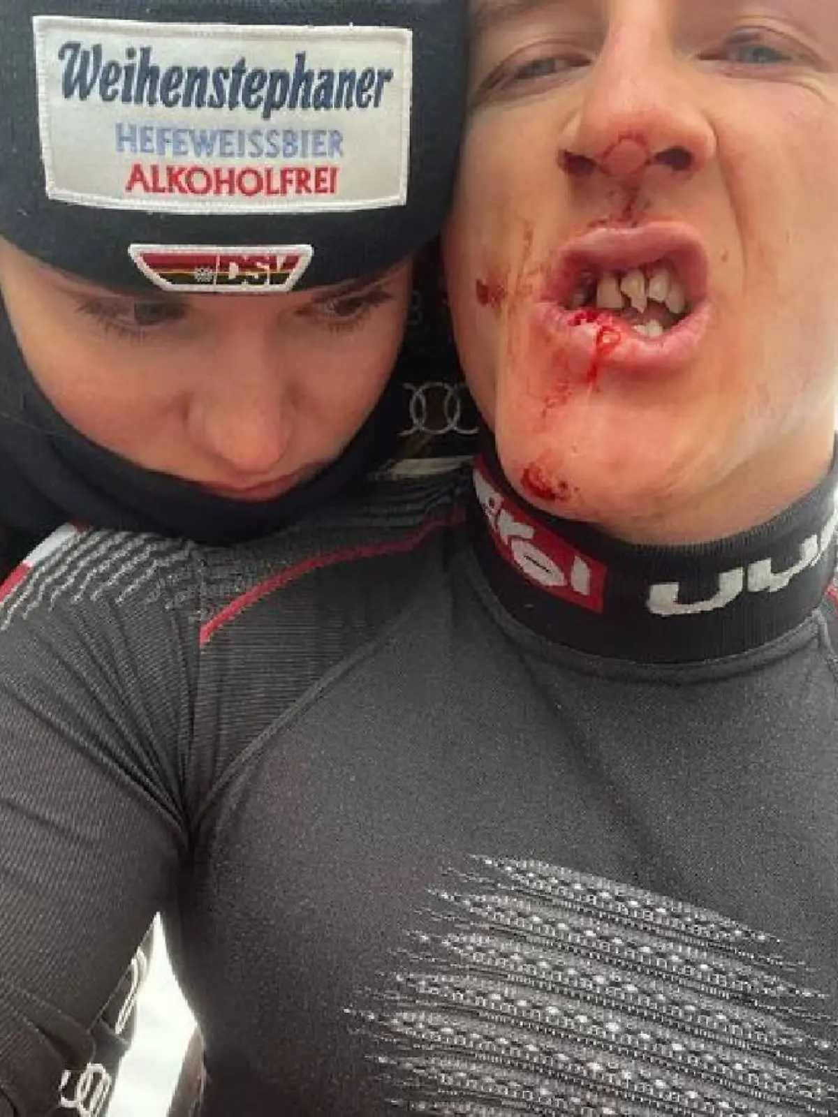 Fabiana Dorigo postet ein Foto von den blutigen Zähnen ihres Freundes Raphael Haaser.
