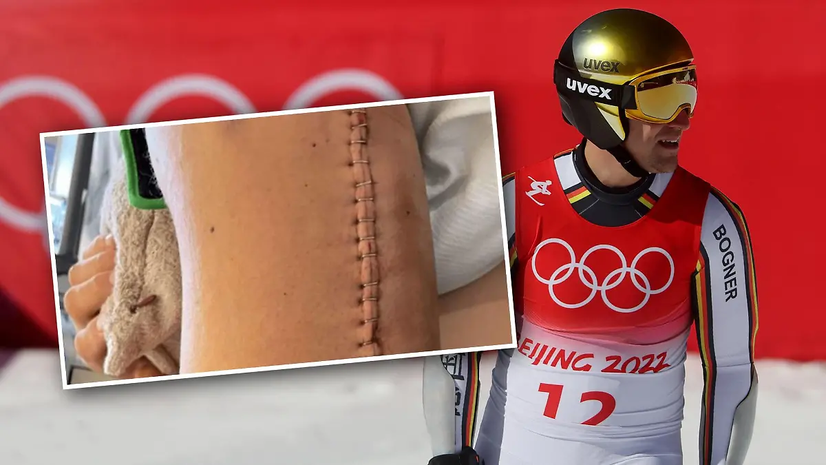 Josef Ferstl zeigt seine Narbe