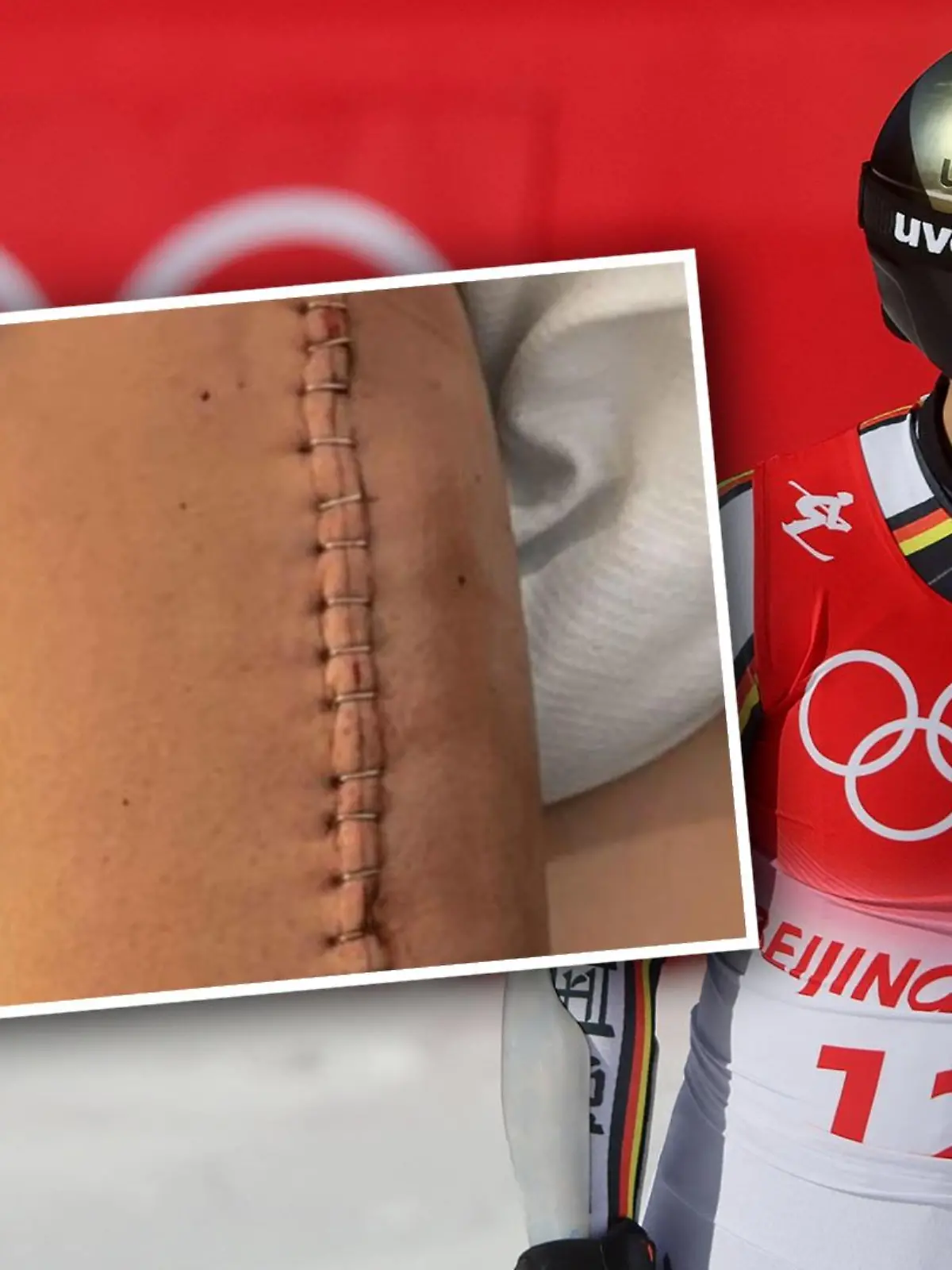 Josef Ferstl zeigt seine Narbe
