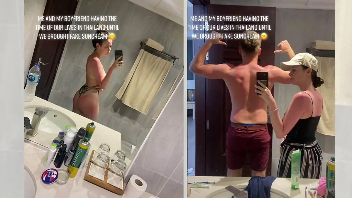Das junge Paar cremt sich mit Fake-Sonnencreme ein und verbrennt komplett.