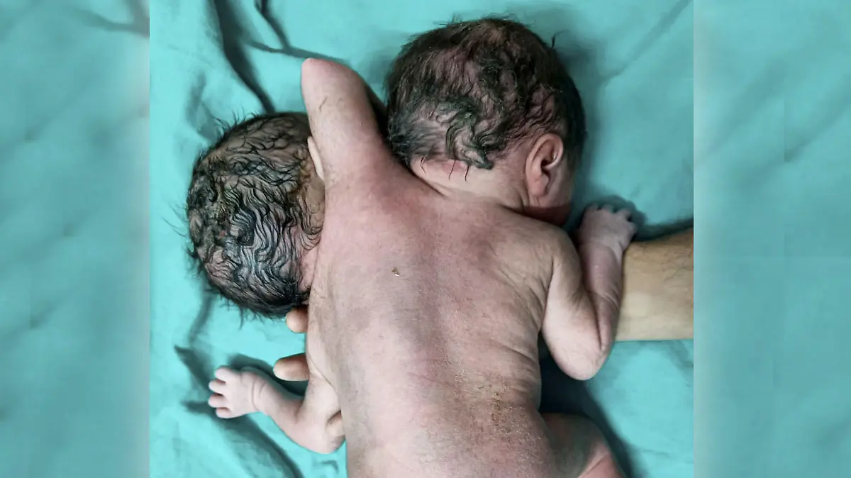 Die dritte Hand der Babys wuchs aus dem Rücken heraus