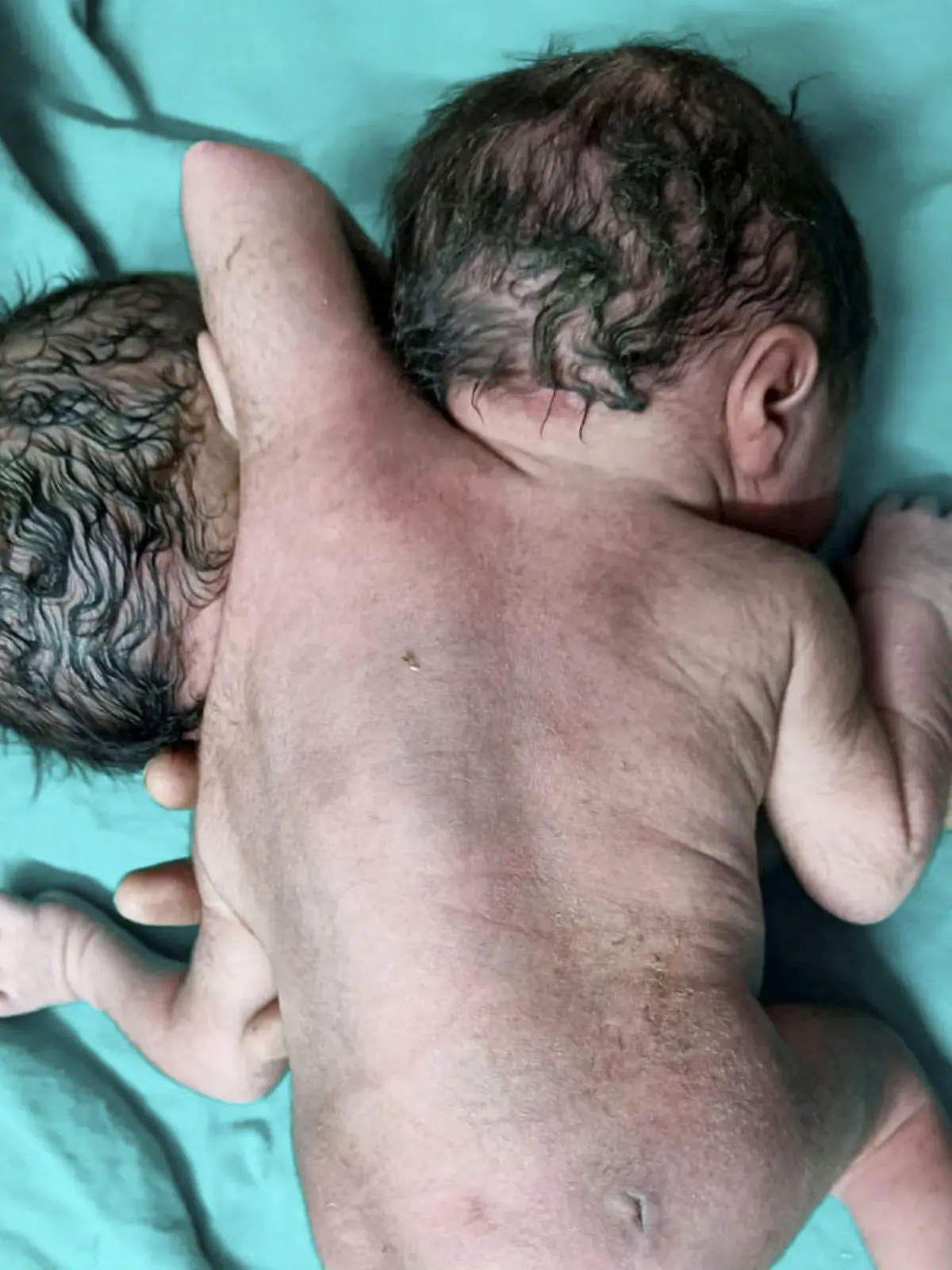Die dritte Hand der Babys wuchs aus dem Rücken heraus