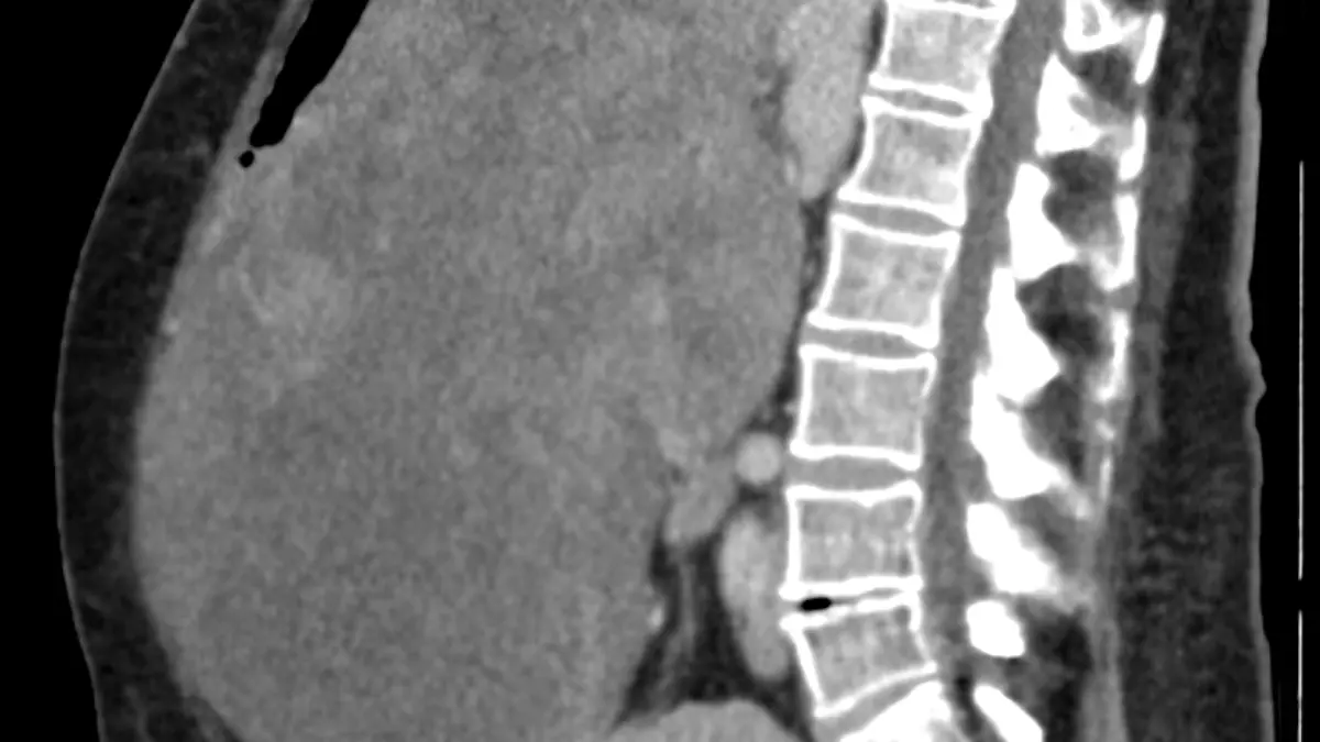 Die große graue Fläche ist der 8,5 Kilo-Tumor, der den ganzen Bauchraum füllt