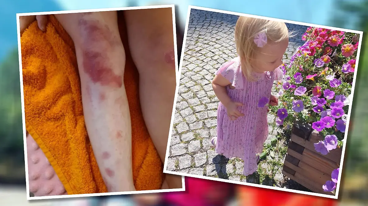 Die kleine Luana hat eine seltene Erkrankung.