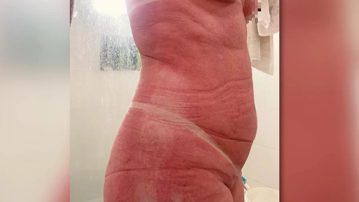 Frau in Sonnenstudio verbrannt Brasilien