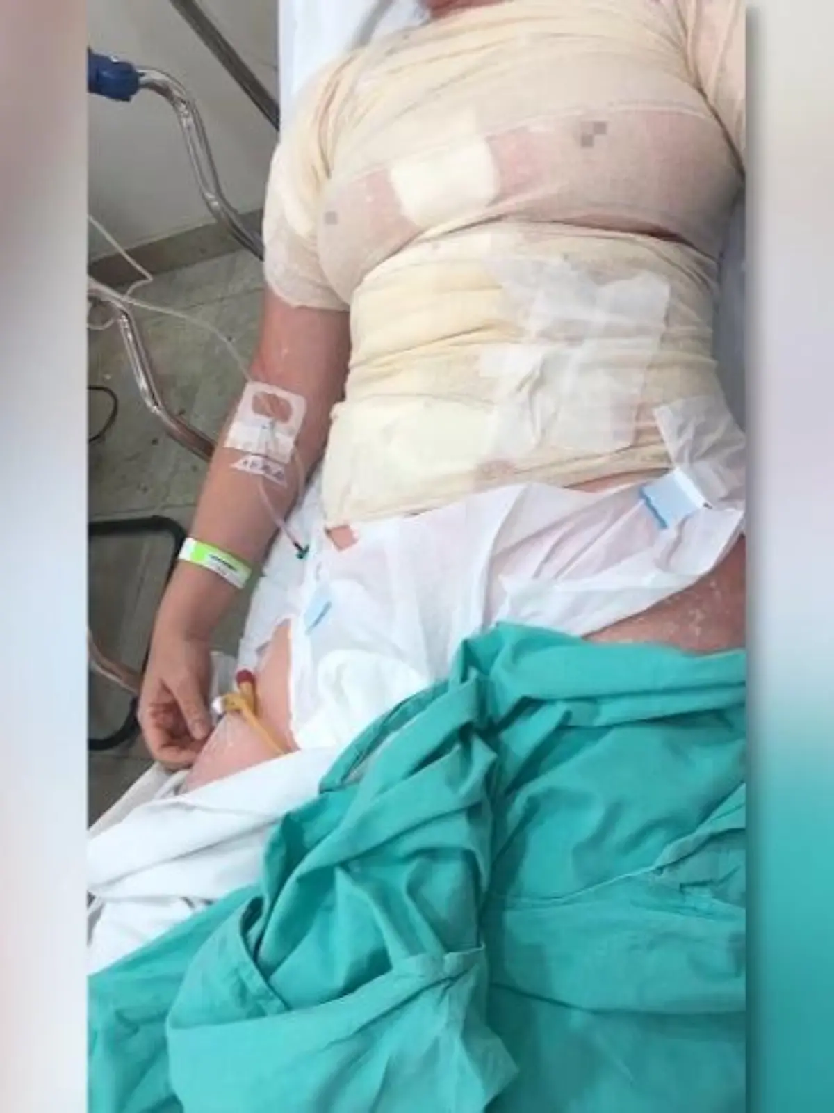 Ein sommerlicher Tan - das wollen viele gerne! So auch die Brasilianerin Gesa Araucho aus Rio de Janeiro, und deshalb geht sie regelmäßig auf die Sonnenbank. Was ihr aber dann passiert, ist der blanke Horror: Sie wird unter den UV-Lampen vergessen und kann sich auch selbst nicht befreien, weil die Sonnenbank klemmt. Was das mit Gesas Haut macht und was die Inhaberin des Solariums zu diesem schrecklichen Unfall sagt - wir haben mit beiden gesprochen. Die ganze unglaubliche Geschichte erzählt RTL-Reporterin Isabell Bures im Video!