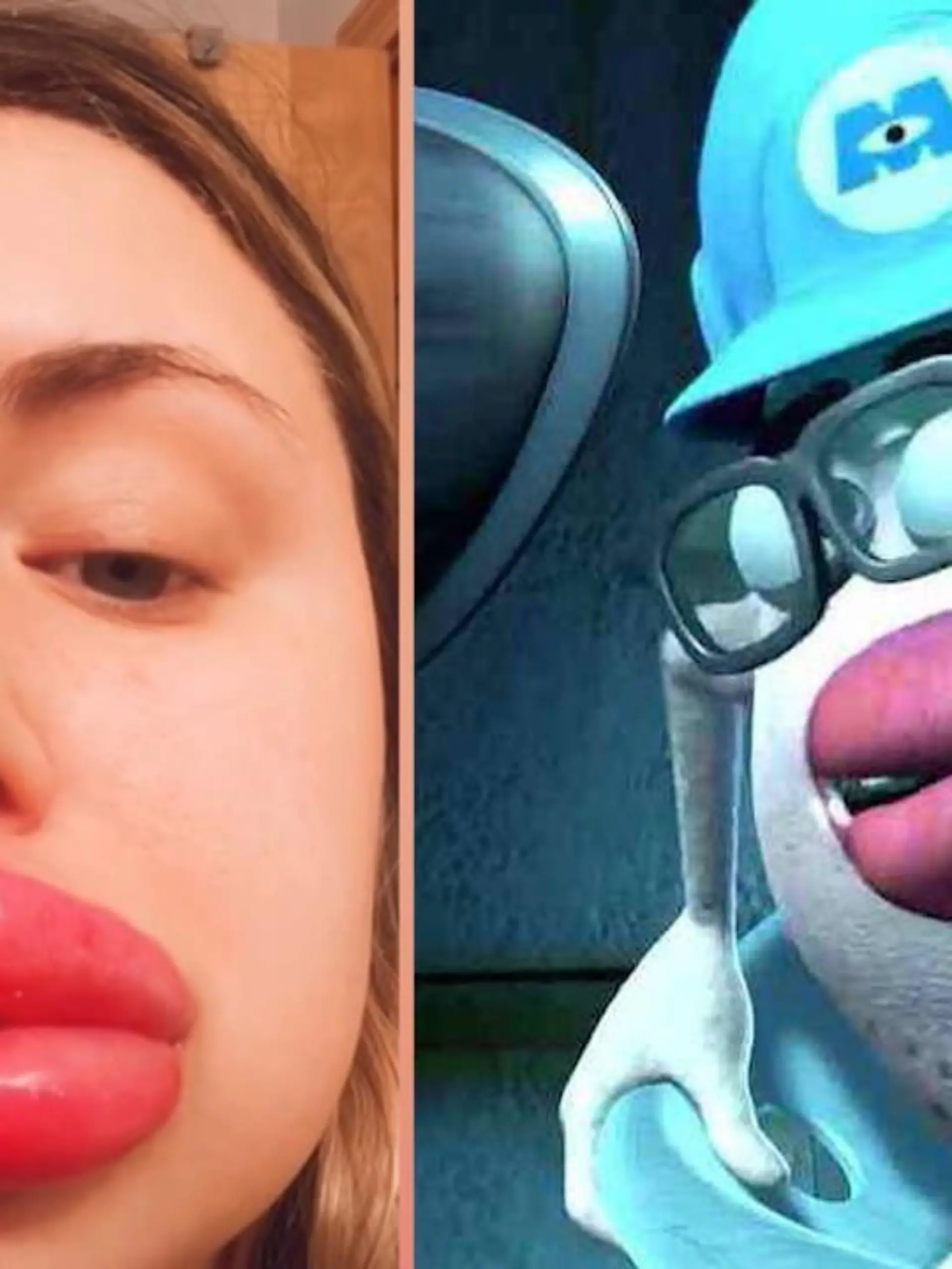Lipfiller sind meistens dafür da, Menschen schönere, vollere Lippen zu geben. Kailee Jones aus Großbrittanien hatte auch diesen Wunsch – nur ist er bei ihr nach hinten losgegangen.