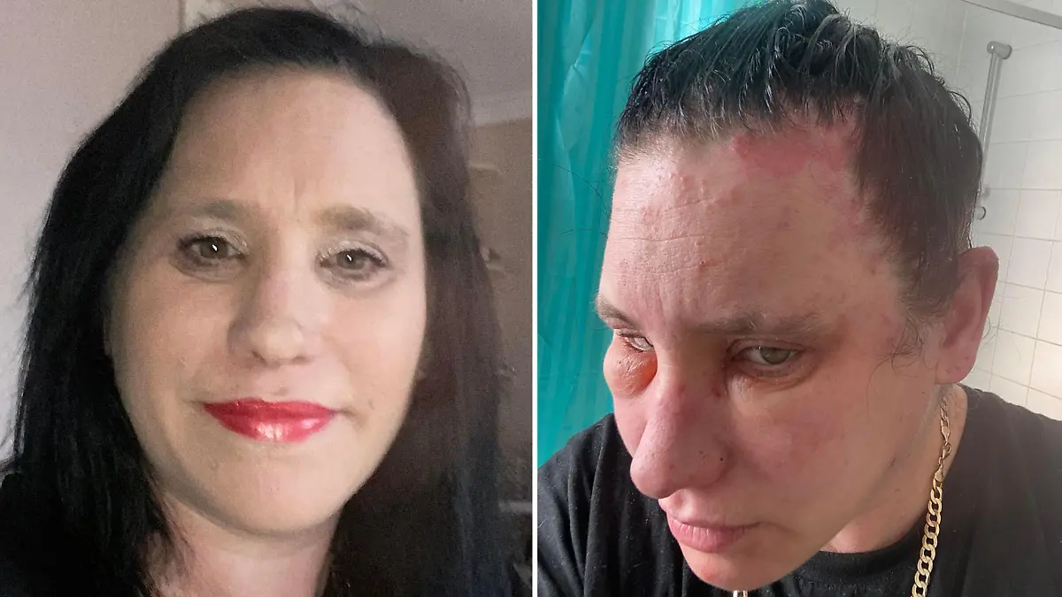 Jessie Sullivan vor und nach der allergischen Reaktion mit geschwollenem Gesicht.