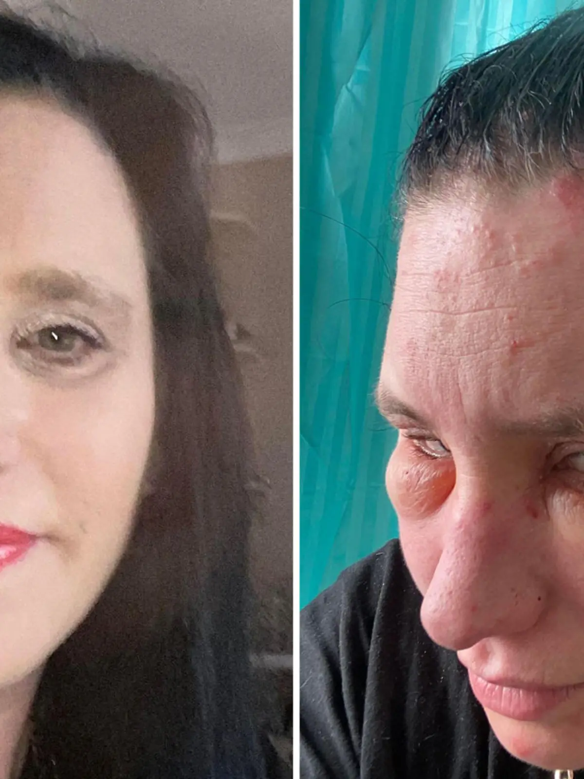 Jessie Sullivan vor und nach der allergischen Reaktion mit geschwollenem Gesicht.