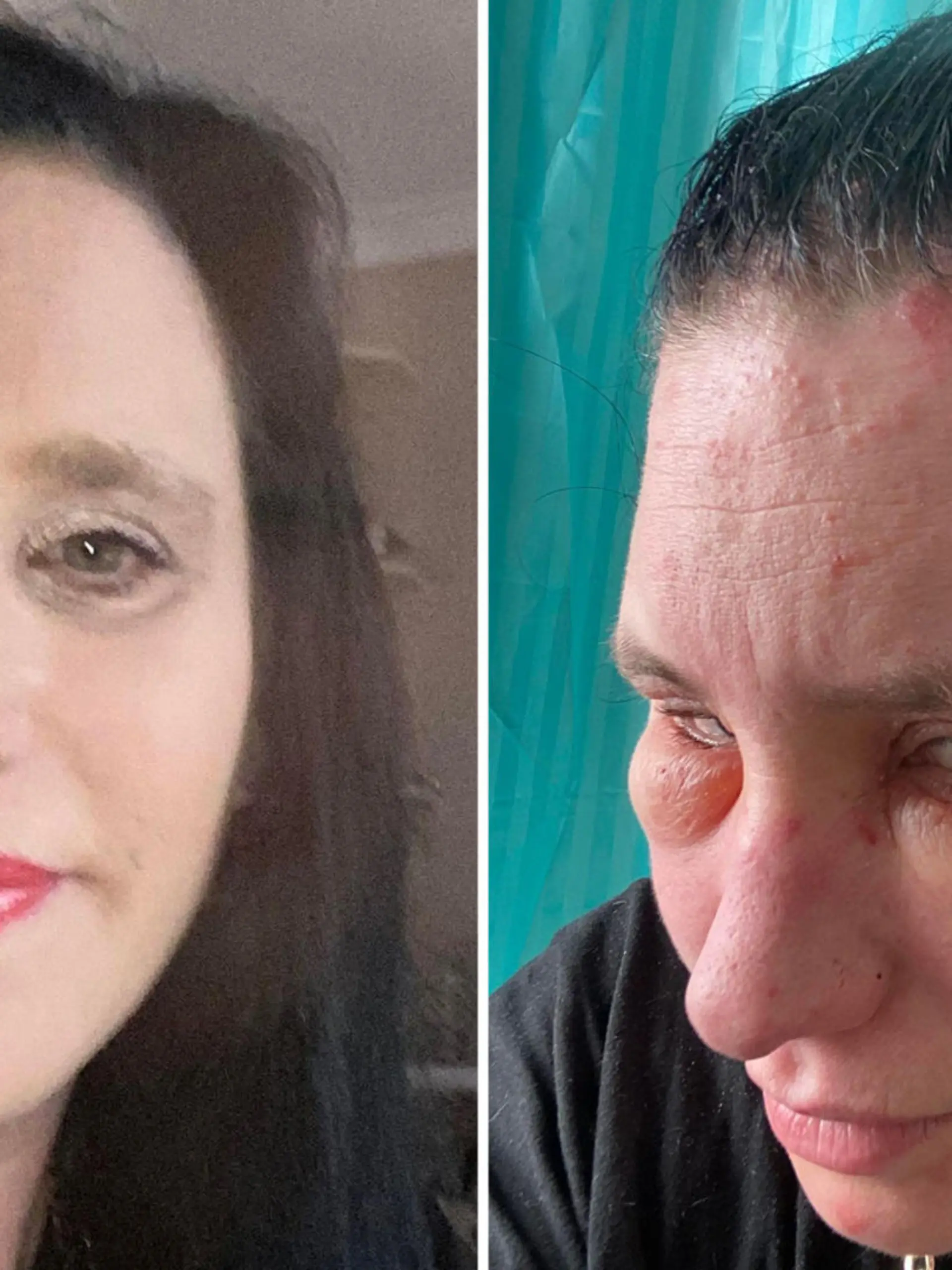Jessie Sullivan vor und nach der allergischen Reaktion mit geschwollenem Gesicht.